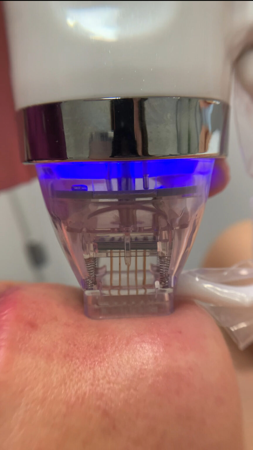 rf mikorigłowa w Gdańsku