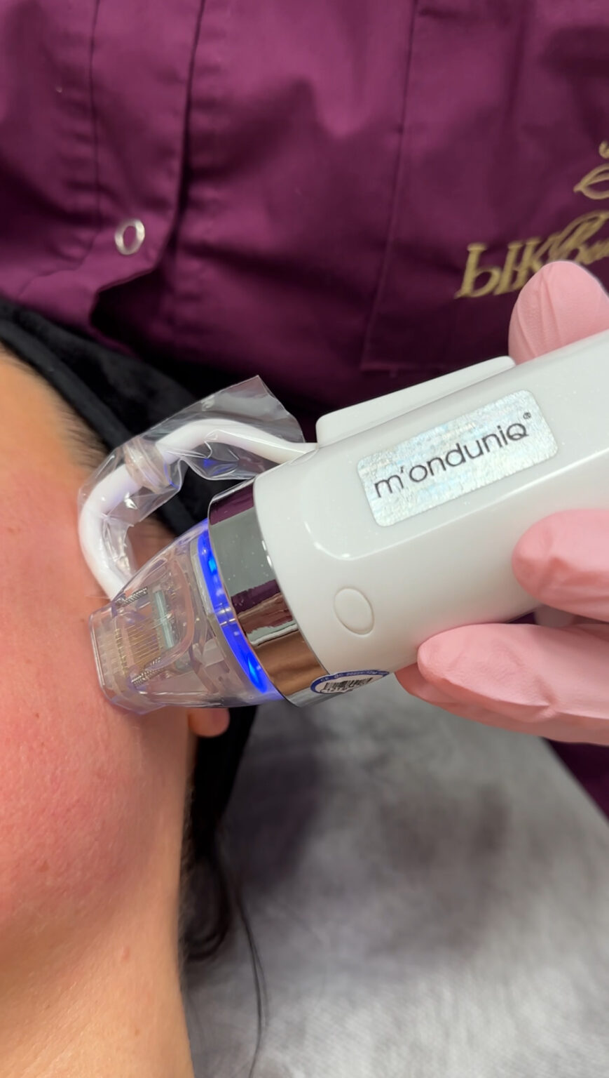 radiofrekwencja mikroigłowa wykonywana w Gdańsku